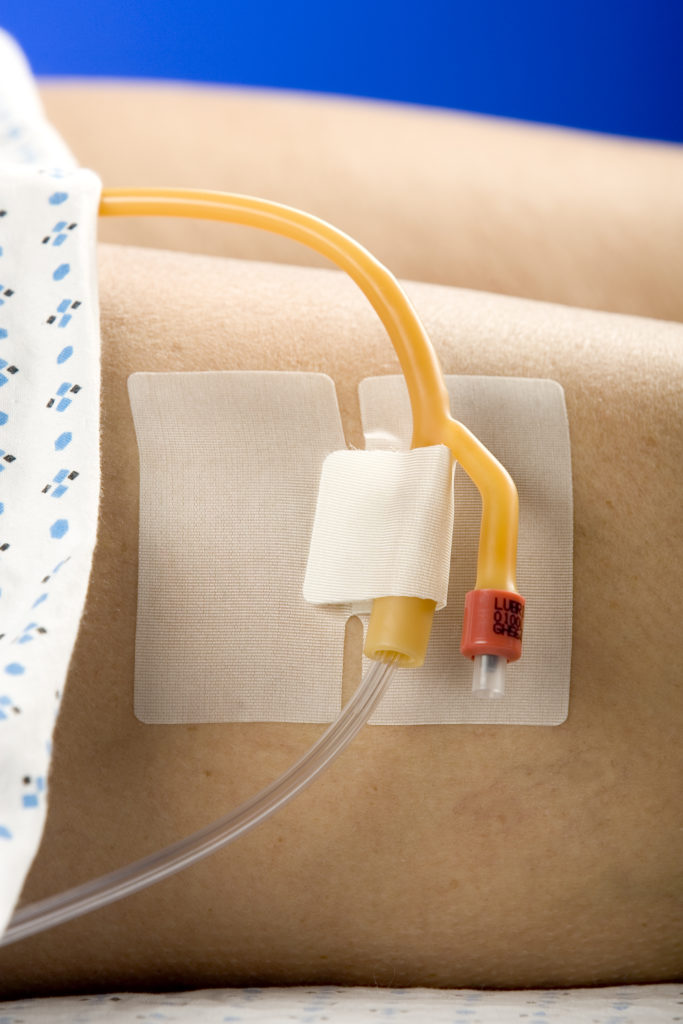 Cath-Secure Tube Holder for Catheters & Medical Tubing
